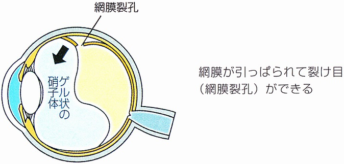 網膜裂孔とは網膜剥離の前兆です。