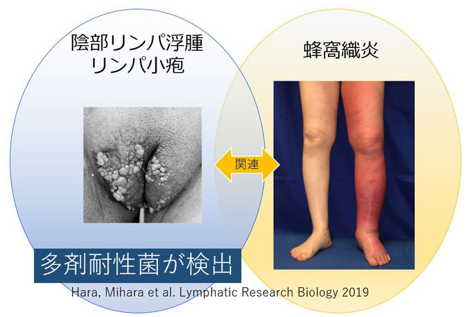 リンパ浮腫　むくみクリニック　蜂窩織炎　リンパ小胞　陰部