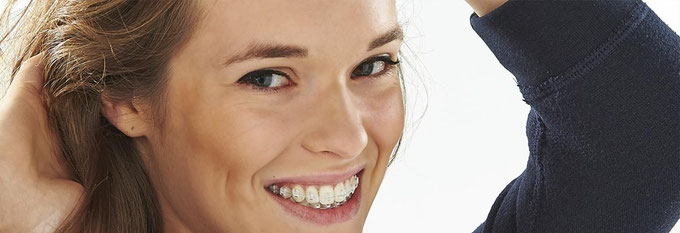 Keramikbrackets durchsichtige Brackets Experience-Brackets