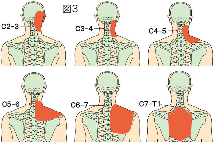 頸椎椎間関節からの関連痛（放散痛）