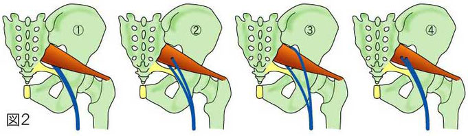 坐骨神経の経路と梨状筋との関係