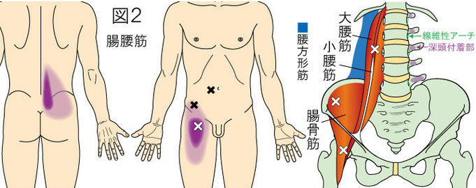 腸腰筋（大腰筋・腸骨筋）トリガーポイントによる腰・鼠径部・大腿部の痛み