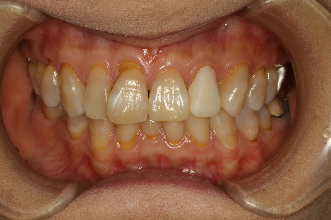 前歯１本の歯茎再生