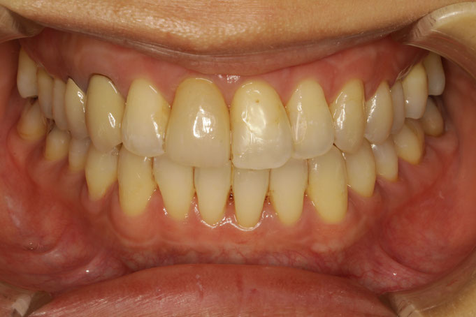 歯茎の再生治療