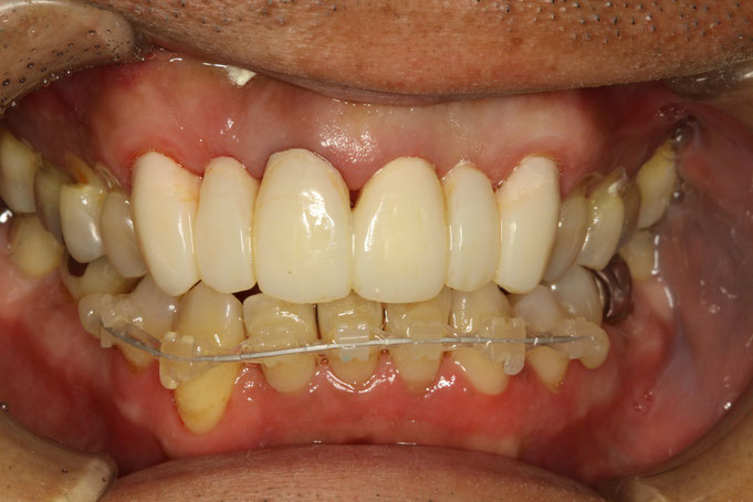 歯茎の治療中の状態