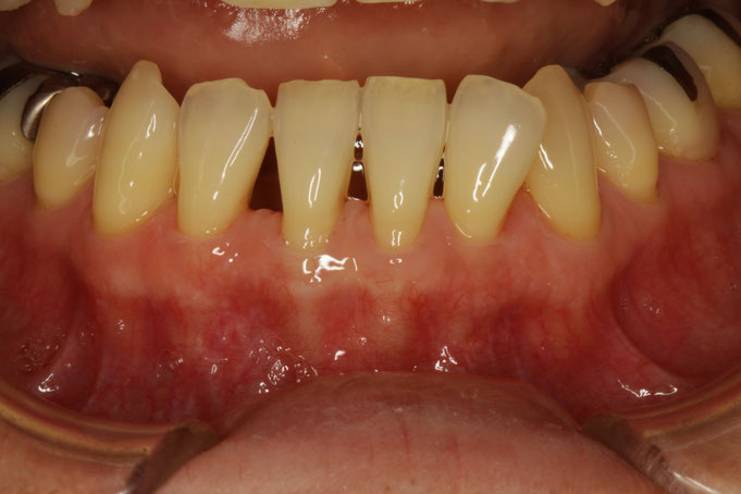 歯茎の再生治療の治療前