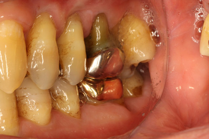 歯を支える骨がない場合は歯茎の再生治療が限定的となります。