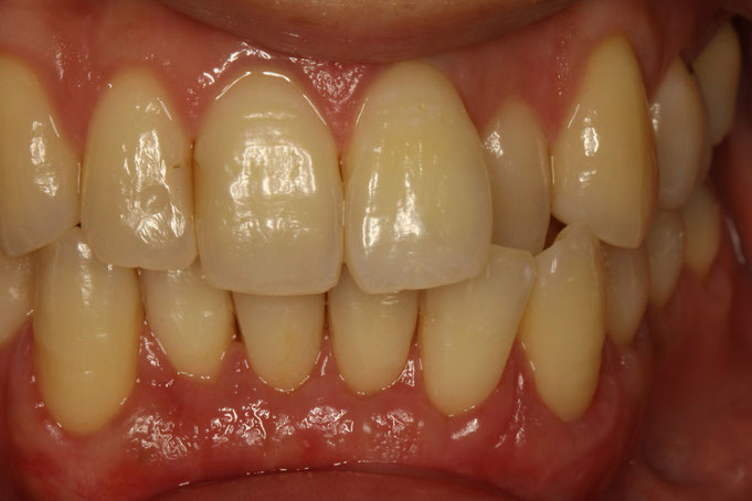 矯正治療前の歯茎の再生