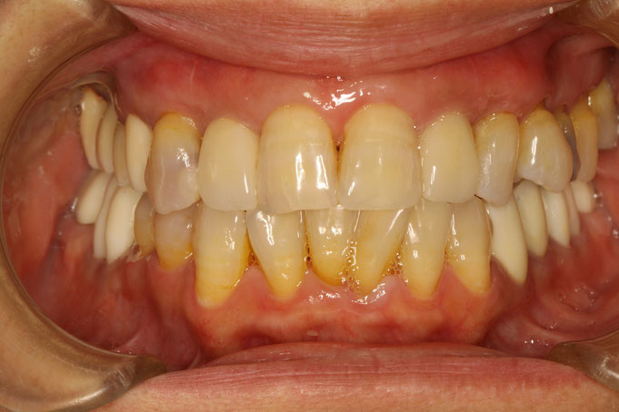 前歯の歯茎が回復したことで見た目が改善しました．