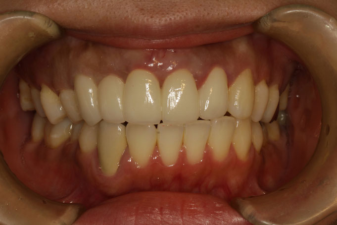 審美歯科と歯茎の再生