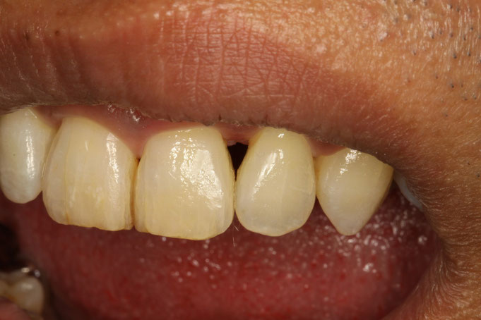 歯と歯の間の隙間