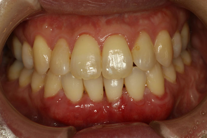 歯茎の再生　１週後の状態