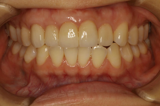 歯ぐきの再生と審美歯科で歯の長さをそろえました