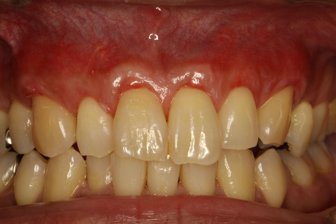 前歯６本の歯茎が下がったケース