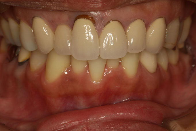 審美歯科と歯茎の黒ずみ