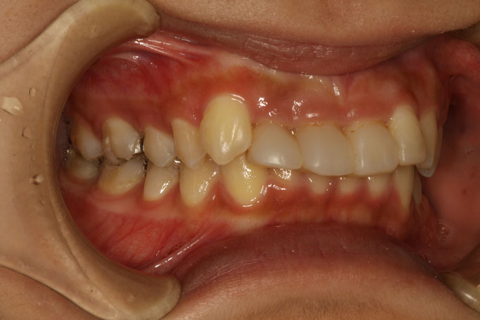 出っ歯で短い差し歯を審美歯科で改善したケース