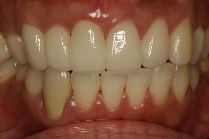 歯の長さを短くする審美歯科治療