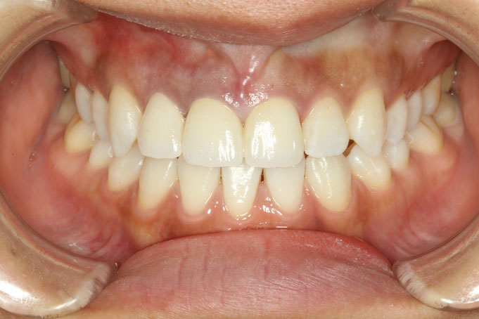 変色歯の審美歯科治療