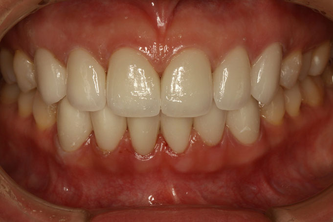 オールセラミック - 審美歯科の専門ページ