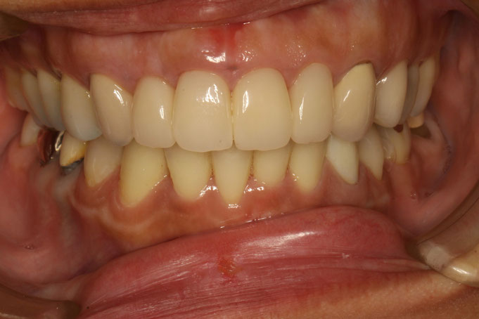 歯ぐきの再生と審美歯科治療の後