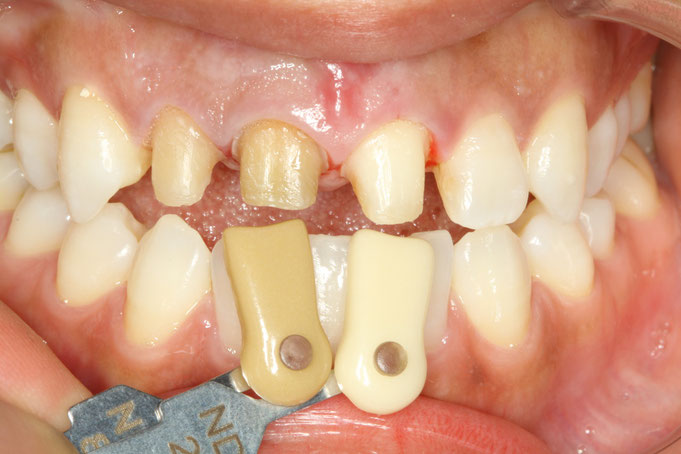 変色歯の治療