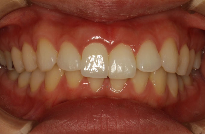 差し歯の歯茎が黒い場合の審美歯科治療