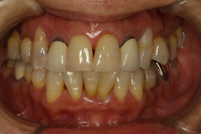 歯茎の黒ずみ