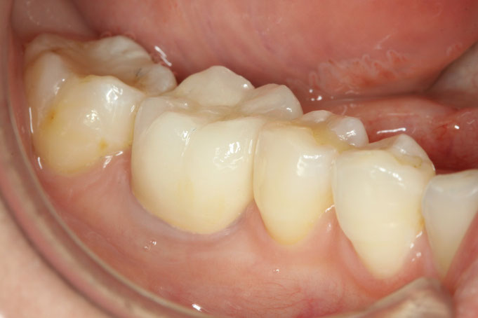 奥歯の審美歯科
