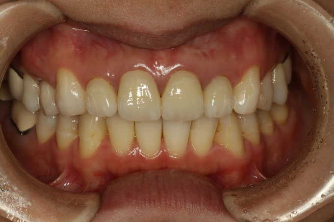 セラミックの差し歯の歯茎が下がってしまう事があります．