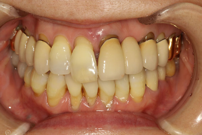 重度の歯周病のかたの審美歯科治療例