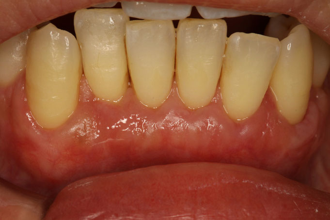 露出した根っこを歯ぐきの再生治療で覆った後の状態