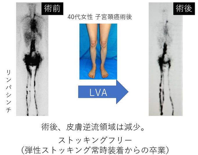 子宮がん　早期リンパ浮腫　予防　日帰りLVA手術　保存療法　三原誠　蜂窩織炎　手術　治療　名医　専門医