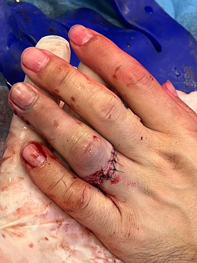 résultat immédiatement après une réimplantation