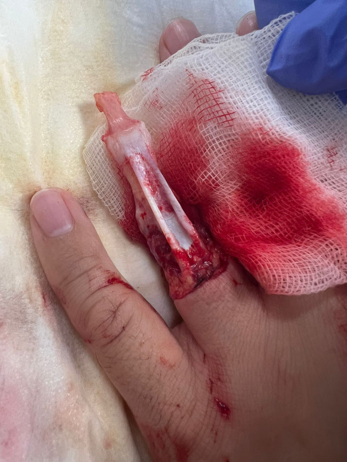 avulsion doigt causée par une bague  