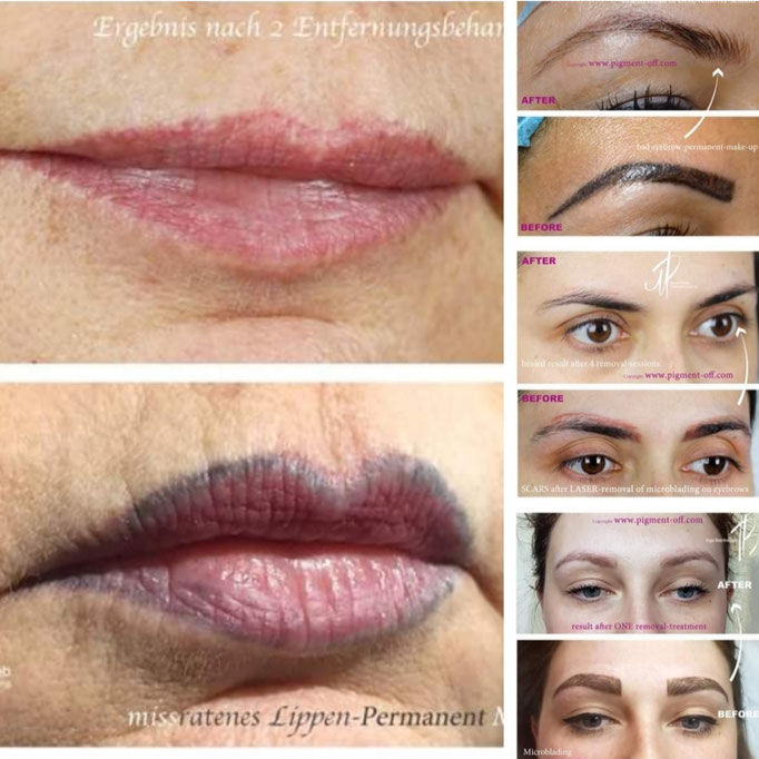 Permanent Make-Up & Microblading Entfernung ohne Laser in Kriens/Schweiz 