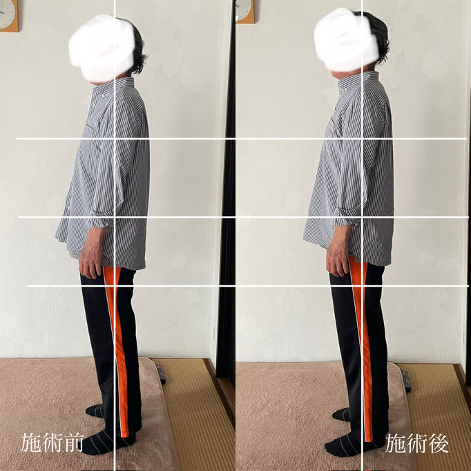 50代男性/耳鳴り/めまい/坐骨神経痛　　　　　（疲れが溜まるとふくらはぎに激しい痛みと自律神経のアンバランスにお困りでした）