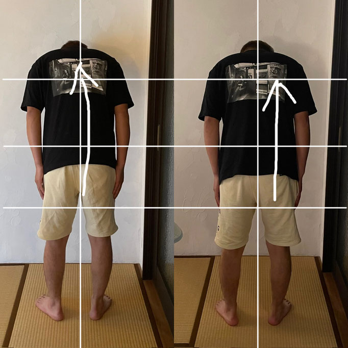 20代男性/鬱による自律神経失調症で全身の痛み (ある日突然、全身に痛みが出たそうでしたが神経の乱れが原因、現在は痛みは解消されました）