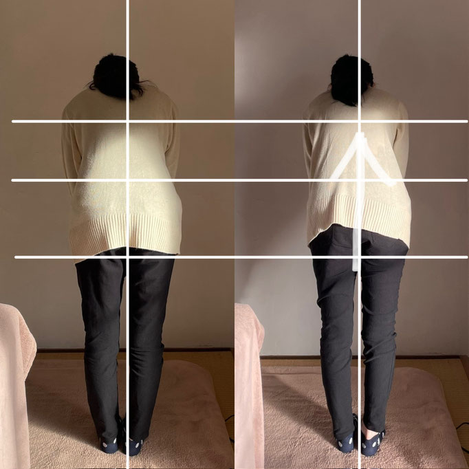 60代女性/腰痛/背中のつまり/脊椎側湾症　　 　(外出中は腰痛で駅のホームに立っているのも困難でしたがだいぶラクに改善されたそうです）