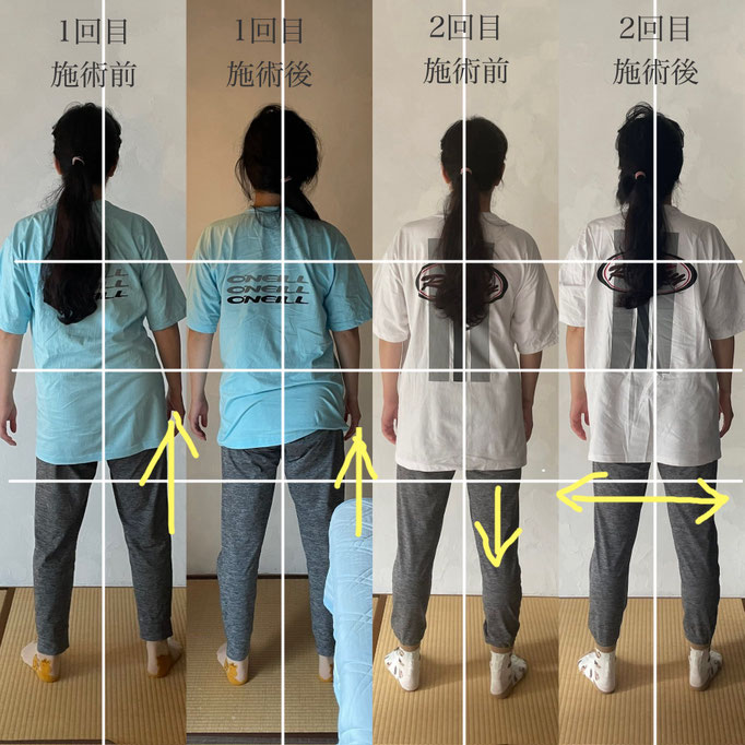 40代女性/自律神経失調症/ぎっくり腰/手のしびれ(3回通っていただきました）