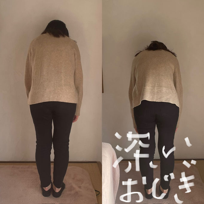 30代女性/足や全身のむくみ/腰痛/首の痛み　 　（疲れてくると骨盤がゆがみ下半身が浮腫むそうでしたが、現在は浮腫まなくなったそうです）