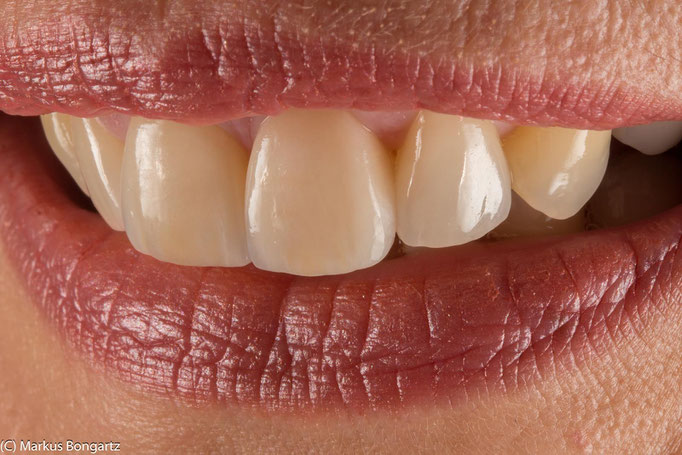 Die eingesetzten Veneers