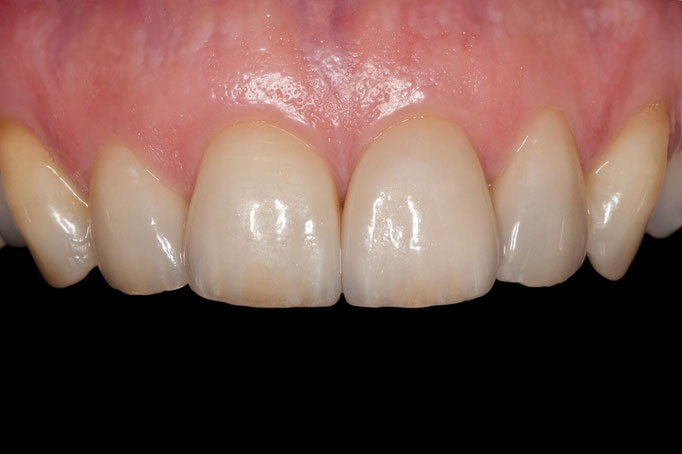 Die eingesetzten Veneers