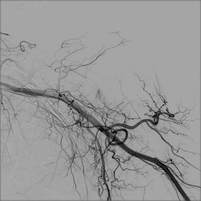 Figure 1. A). Patient with adhesive capsulitis. Angiography of the left shoulder showing pathologic arterial blush in the axillary recess and in the acromioclavicular joint. 