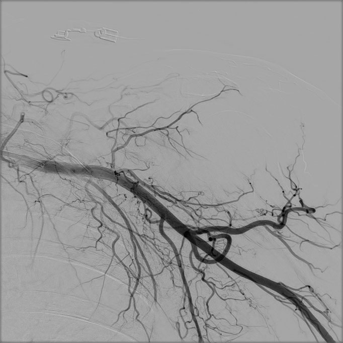 Figure 1. B). Disappearance of the areas of hypervascularization after the embolization.