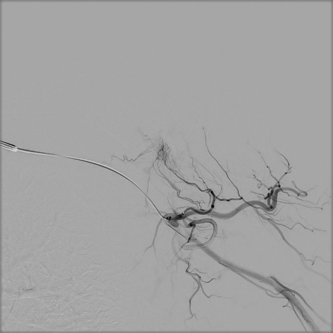 Figure 2. Selective microcatheterization of the anterior humeral circumflex artery where the blush area of the axillary recess is identified in Figure 1.