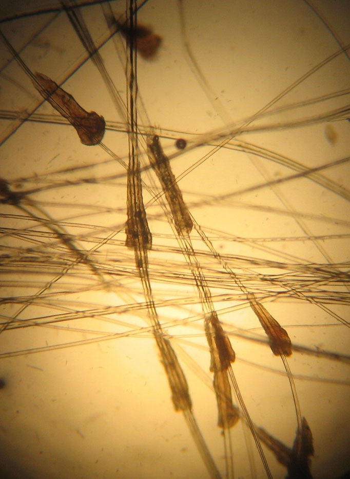 Follicular Cast (Keratinmanschetten) an den Haaren bei Demodikose
