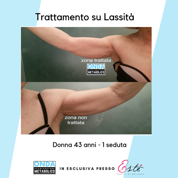 Storz Medical onda acustica cellulite tonificazione centro estetico Prata di Pordenone 