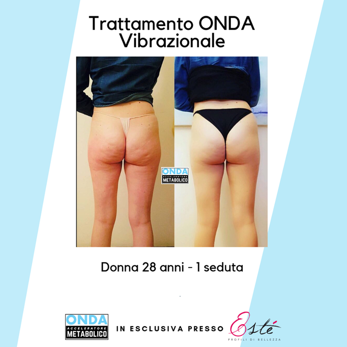 Storz Medical onda acustica cellulite tonificazione centro estetico Prata di Pordenone 