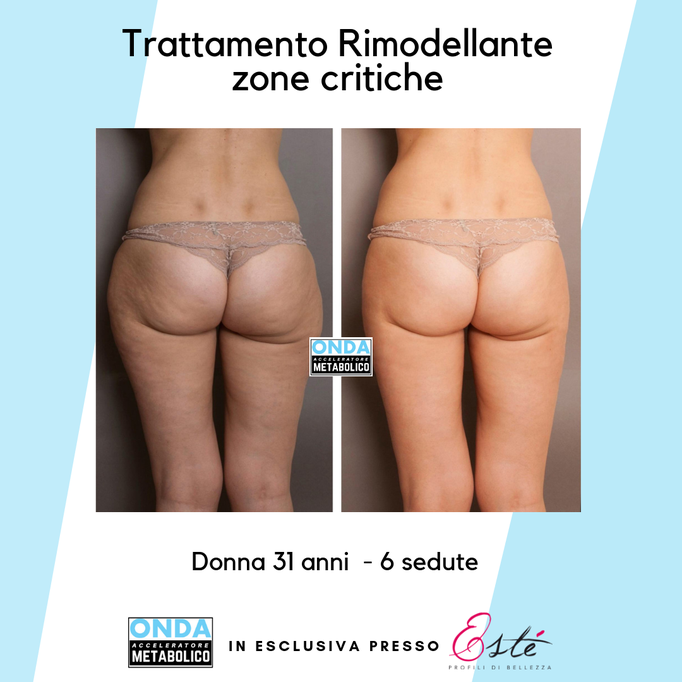 Storz Medical onda acustica cellulite tonificazione centro estetico Prata di Pordenone 