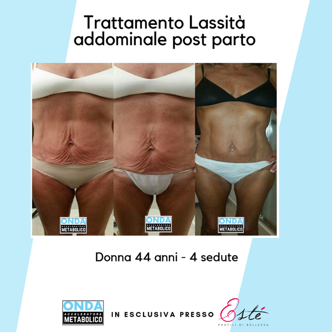 Storz Medical onda acustica cellulite tonificazione centro estetico Prata di Pordenone 